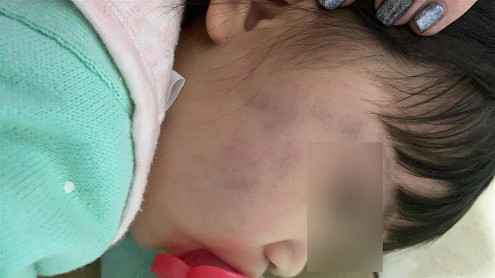 Thấy mặt con nhỏ bầm tím, bố mẹ kiểm tra camera tức điên khi thấy hành động của giúp việc-1