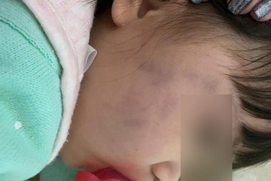 Thấy mặt con nhỏ bầm tím, bố mẹ kiểm tra camera tức điên khi thấy hành động của giúp việc