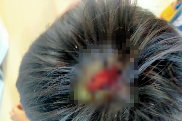 Gia Lai: Bé trai 9 tuổi nghi bị bố bạo hành dã man, rách nguyên mảng da đầu-1