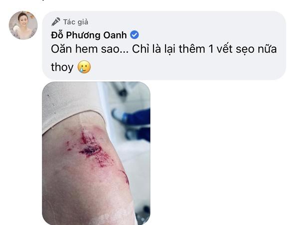 Sao Việt xót xa khi Phương Oanh bị thương trong lúc quay phim-10