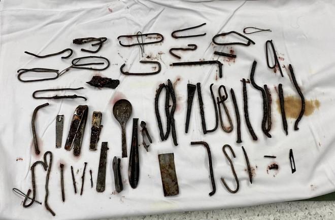 Sốc: Bác sĩ tìm thấy 1kg đinh, thìa, dao trong bụng thanh niên ở Bình Dương-1