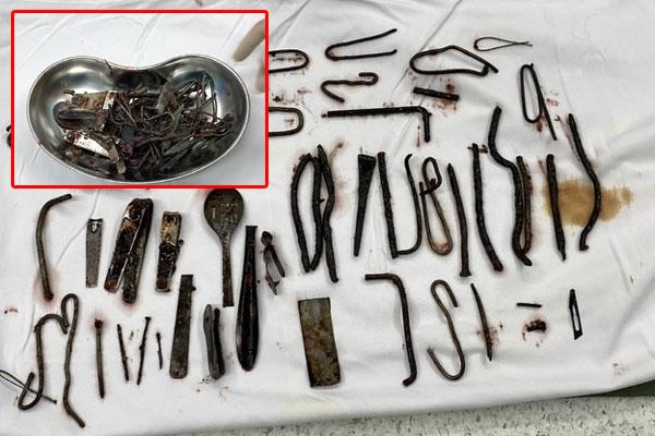 Rùng mình:  Bác sĩ nội soi lấy hơn 50 viên sỏi trong khớp háng của người phụ nữ-4