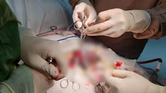 Đang đi bộ trên đường, nam thanh niên ở TP HCM bất ngờ gãy cậu nhỏ vì lý do khó đỡ-2