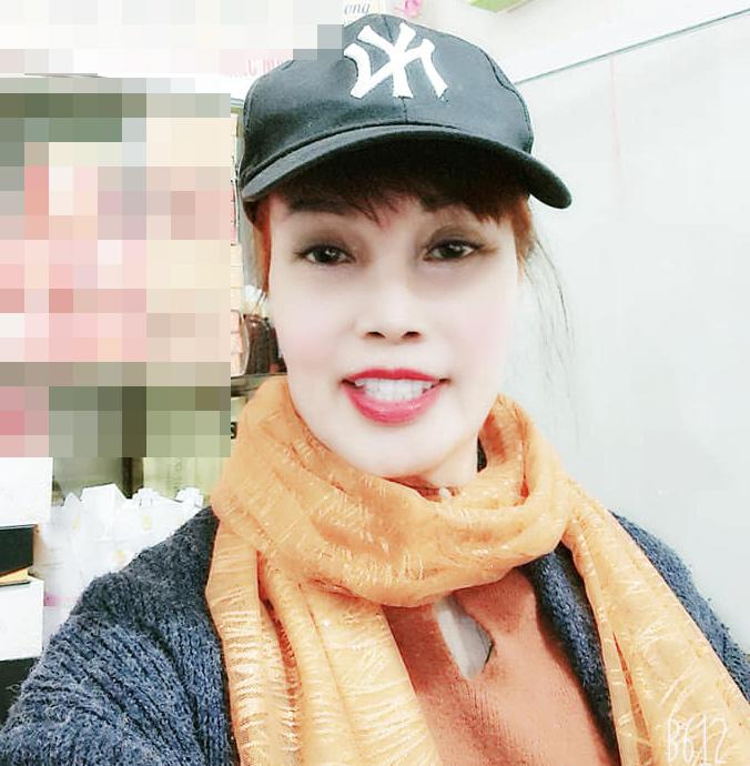 Gương mặt đơ cứng, méo lệch của cô dâu 64 tuổi sau hơn nửa năm dao kéo-4