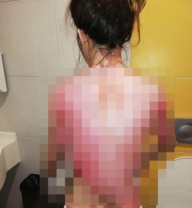 Chồng thú tính dội nước sôi lột da vợ chỉ vì... bị gọi dậy ăn sáng-2