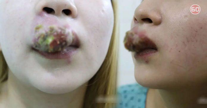 Xăm môi 2 triệu đón Tết, cô gái nhận cái kết sưng tều như mỏ chim-1