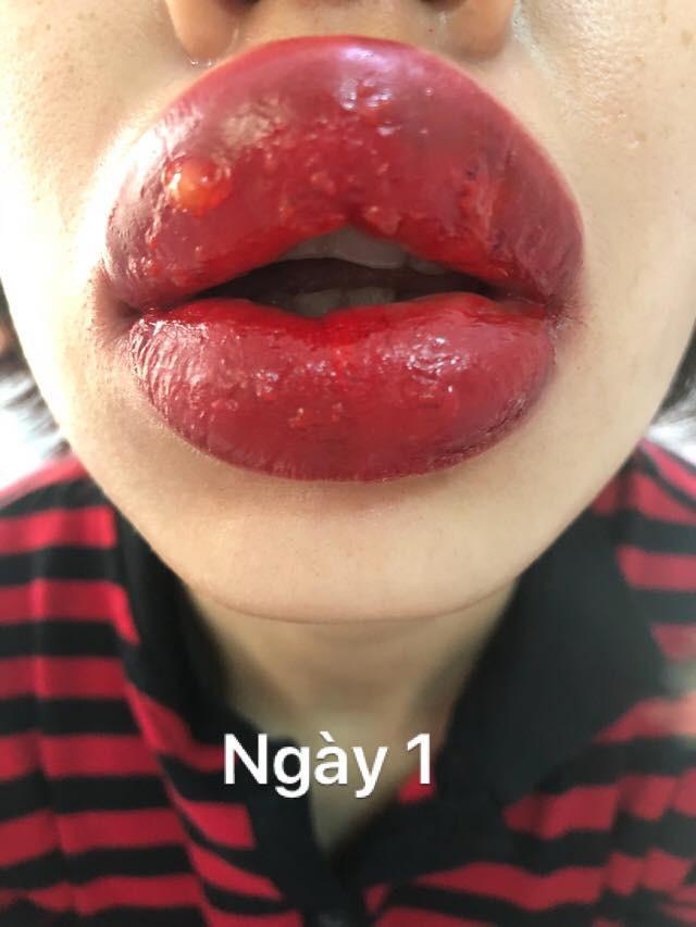 Xăm môi 2 triệu đón Tết, cô gái nhận cái kết sưng tều như mỏ chim-6