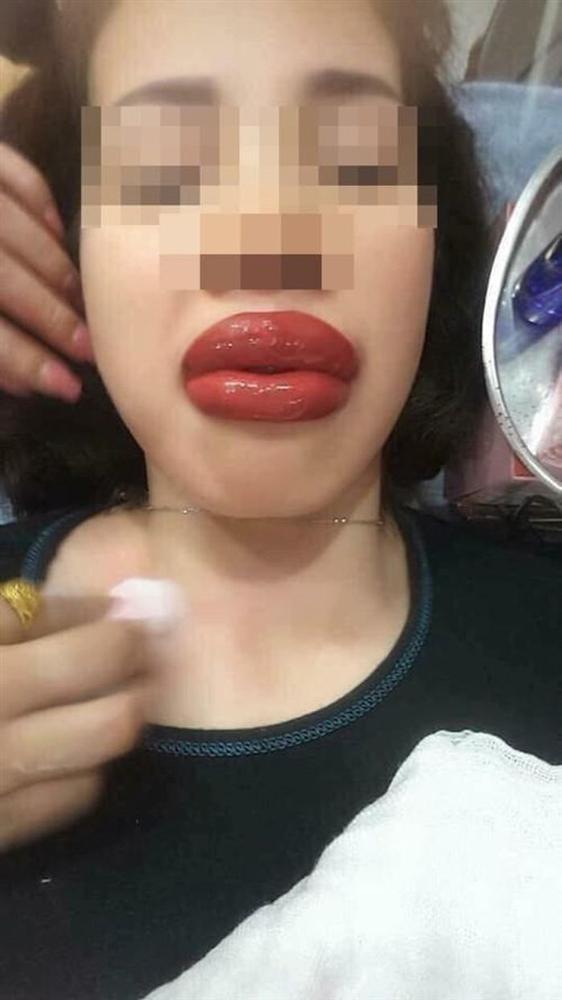 Xăm môi 2 triệu đón Tết, cô gái nhận cái kết sưng tều như mỏ chim-7