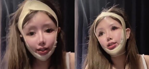 Chi 14 tỷ phẫu thuật thẩm mỹ 100 lần, cô gái bị biến dạng khuôn mặt-4