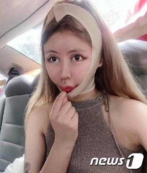 Chi 14 tỷ phẫu thuật thẩm mỹ 100 lần, cô gái bị biến dạng khuôn mặt-5