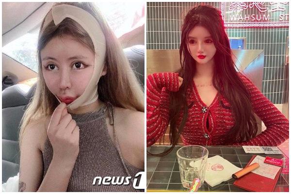 Diễn viên Trung Quốc thẩm mỹ biến dạng hoại tử mũi-4