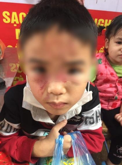 Cháu bé bị bố ruột bạo hành, đánh đập dã man tại Hà Nội khiến dân mạng phẫn nộ-2