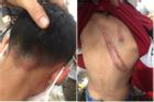 Cháu bé bị bố ruột bạo hành, đánh đập dã man tại Hà Nội khiến dân mạng phẫn nộ