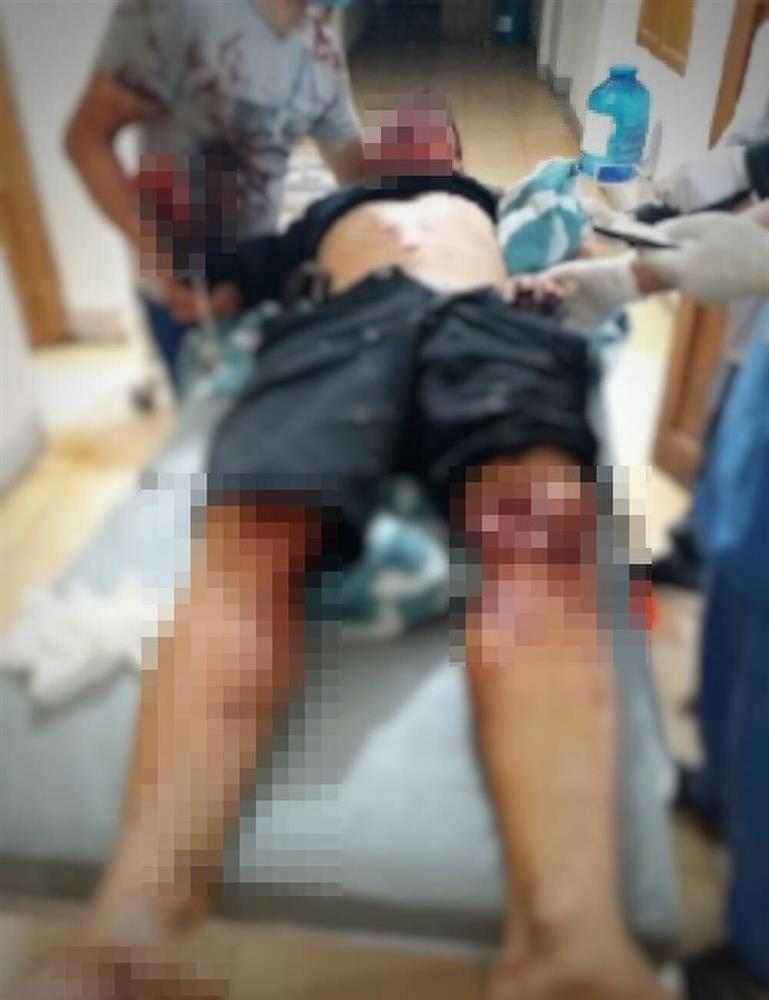 Hà Tĩnh: Nam thanh niên bị mất bàn tay sau vụ nổ lớn-1