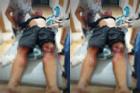 Hà Tĩnh: Nam thanh niên bị mất bàn tay sau vụ nổ lớn