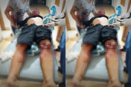 Hà Tĩnh: Nam thanh niên bị mất bàn tay sau vụ nổ lớn