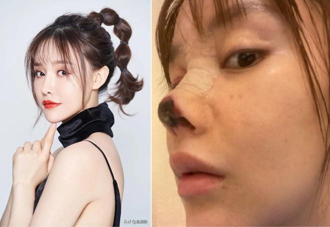 Trịnh Sảng và những mỹ nhân Hoa ngữ thừa nhận thẩm mỹ hỏng-6