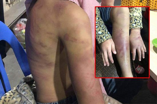 Clip: Mẹ đẻ dùng dây điện quật nát thịt con gái, để người tình xâm hại bé nhiều lần