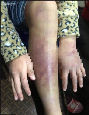 Xót xa bố đẻ bé gái 12 tuổi nghi bị mẹ và người tình bạo hành dã man ở Hà Nội-2