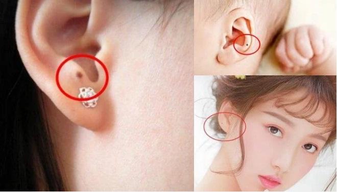 Nốt ruồi ở tai nói trước tương lai của bạn?-1