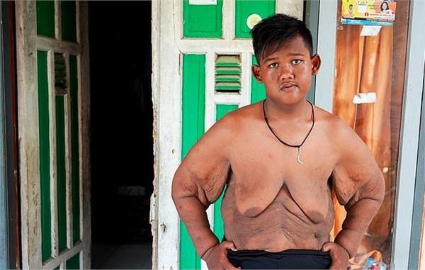 Bất ngờ ngoại hình hiện tại của cậu bé 11 tuổi nặng 382 kg-3