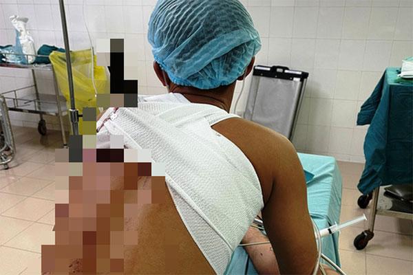 Kinh hoàng: Thanh niên đến viện với con dao xuyên từ lưng qua ngực-1