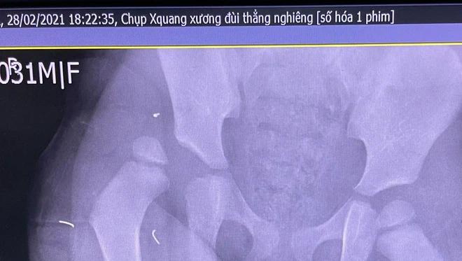 Chụp CT não bé gái rơi từ tầng 13: Bác sĩ cũng không thể tưởng tượng!-2