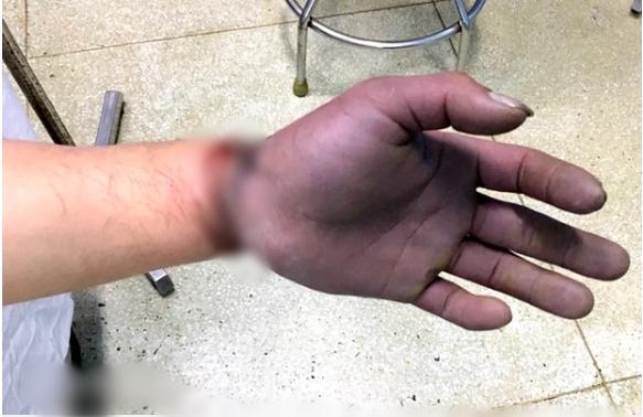 Nam thanh niên bị cuộn kẽm siết chặt, dập nát toàn bộ ngón tay-1