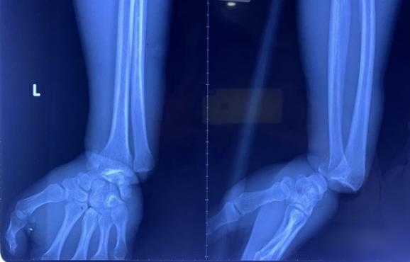 Nam thanh niên bị cuộn kẽm siết chặt, dập nát toàn bộ ngón tay-2