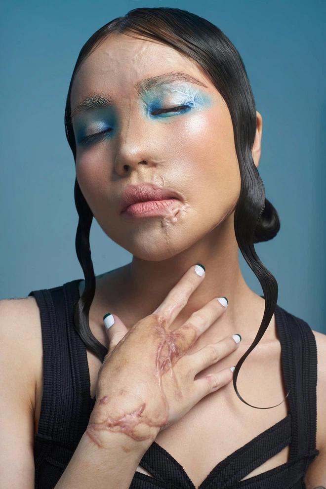 Cô gái Đà Nẵng bị chồng sắp cưới tạt axit khoe ngoại hình mới-7