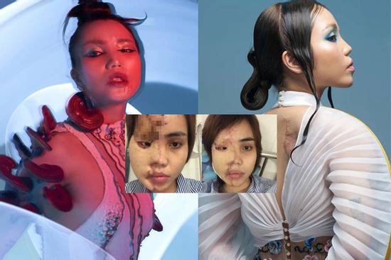 Cô gái Đà Nẵng bị chồng sắp cưới tạt axit khoe ngoại hình mới