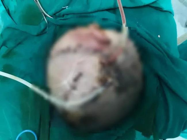 Bé trai hơn 4 tuổi bị chó nhà cắn phải phẫu thuật não-1