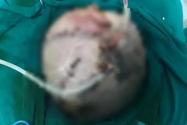 Nghệ An: Bé gái 19 tháng tuổi bị đinh dài 3cm đâm xuyên mắt-3