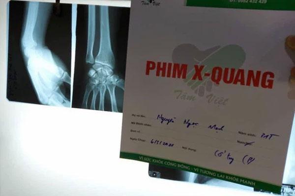 Nguyễn Ngọc Mạnh cứu bé gái rơi từ tầng 13 bị rạn xương ngón tay, chưa thể lái xe-3