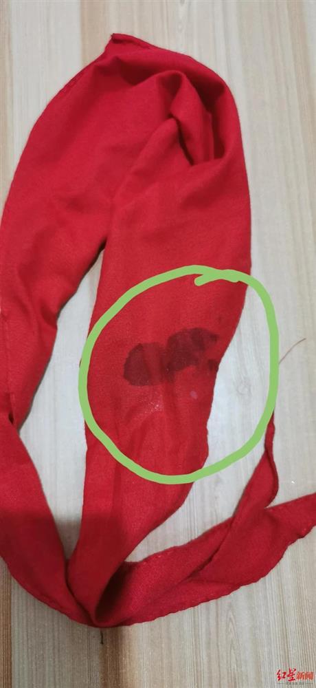 Làm sai bài tập, bé gái 8 tuổi bị cô giáo đánh suýt mù, nhét phấn vào mũi cầm máu-4