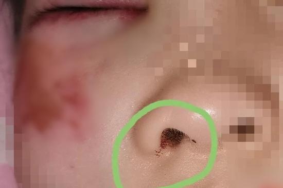 Làm sai bài tập, bé gái 8 tuổi bị cô giáo đánh suýt mù, nhét phấn vào mũi cầm máu