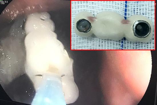 Và vội miếng cơm, người phụ nữ nuốt luôn 4 chiếc răng giả