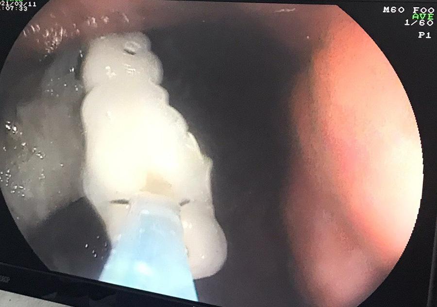 Và vội miếng cơm, người phụ nữ nuốt luôn 4 chiếc răng giả-1