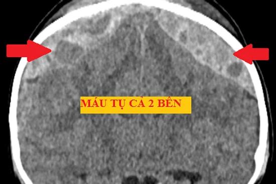 Cưa hộp sọ cứu bé trai xuất huyết não do ngã giường tầng