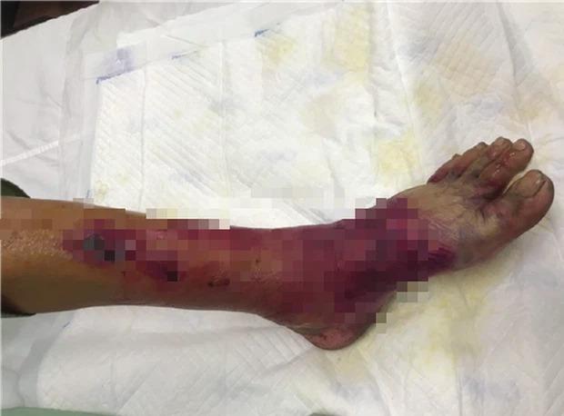 Ngư dân bị sốc nhiễm trùng sau khi chạm vào vi khuẩn ăn thịt người-2