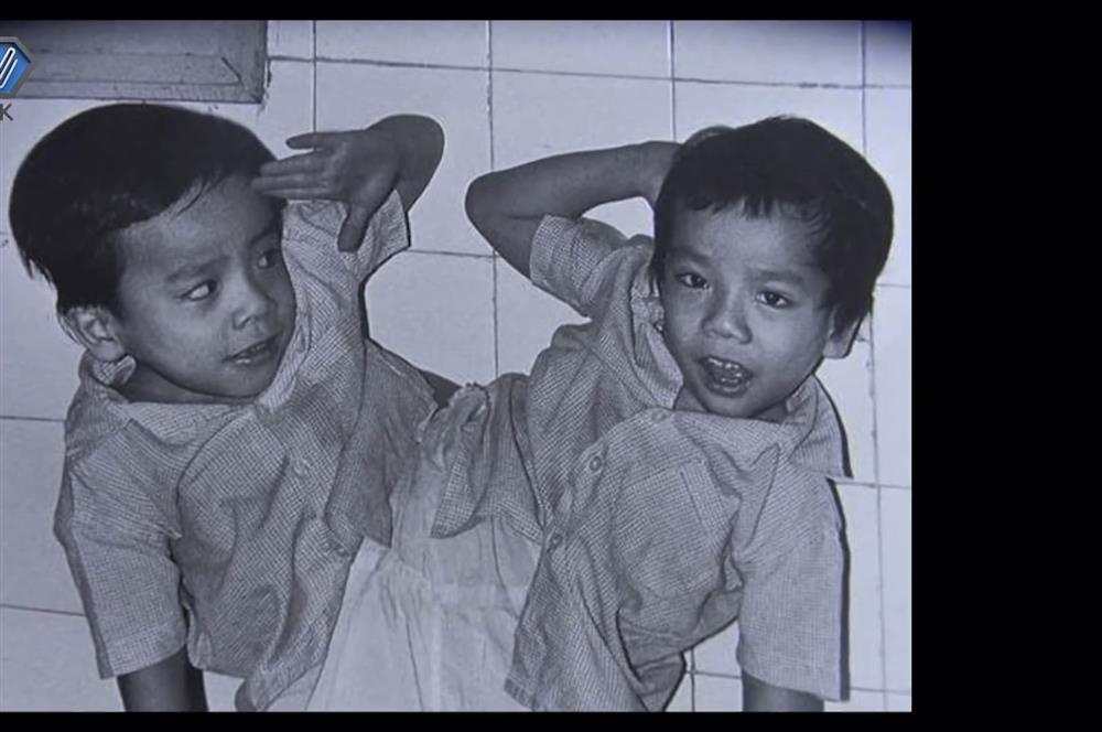 Cặp song sinh dính liền đầu tiên ở Việt Nam sống thế nào sau 33 năm phẫu thuật?-2