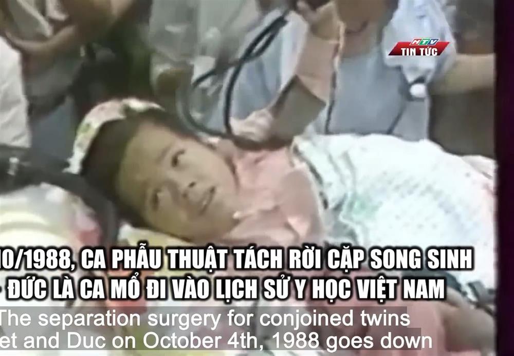 Cặp song sinh dính liền đầu tiên ở Việt Nam sống thế nào sau 33 năm phẫu thuật?-1