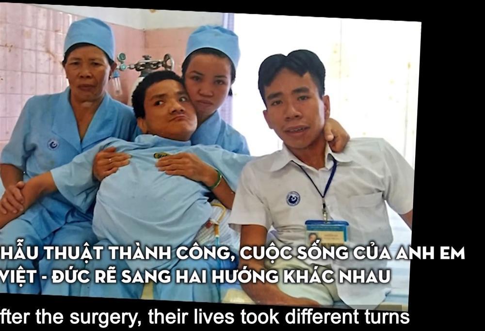 Cặp song sinh dính liền đầu tiên ở Việt Nam sống thế nào sau 33 năm phẫu thuật?-4