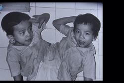 Cặp song sinh dính liền đầu tiên ở Việt Nam sống thế nào sau 33 năm phẫu thuật?