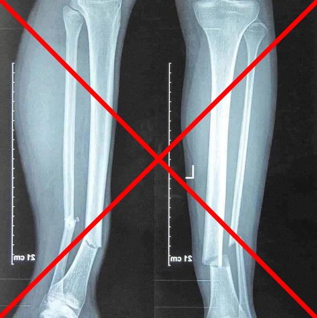 Sự thật hình ảnh chụp X-quang gãy chân của Hùng Dũng-1