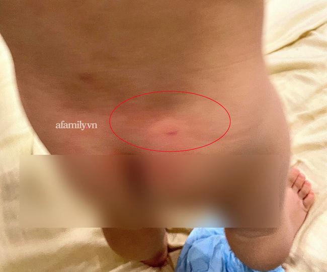 Phụ huynh ở Hà Nội phản ánh con 16 tháng đi học bị cấu và xịt nước nóng-1