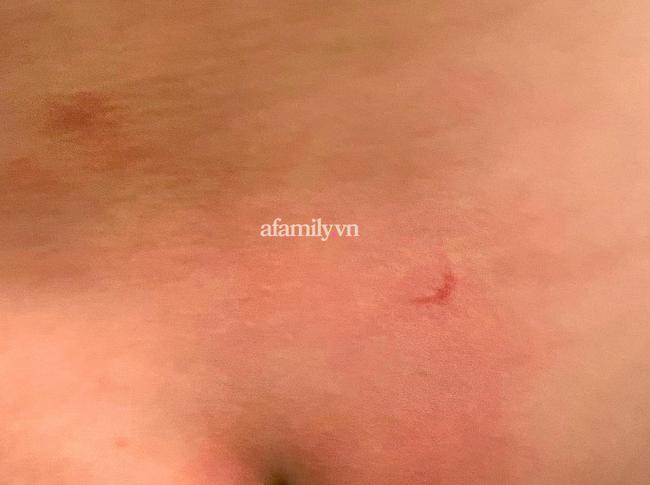 Phụ huynh ở Hà Nội phản ánh con 16 tháng đi học bị cấu và xịt nước nóng-2