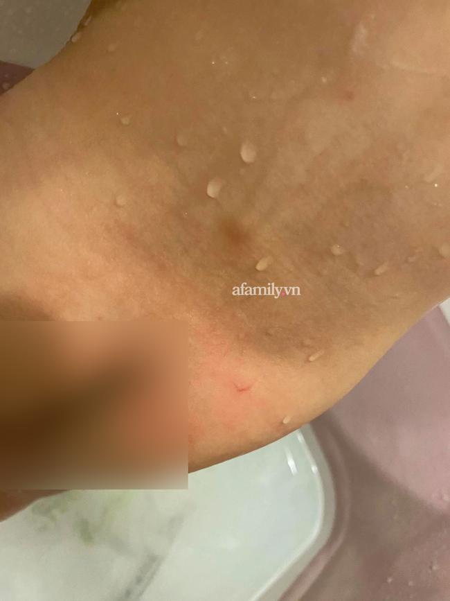 Phụ huynh ở Hà Nội phản ánh con 16 tháng đi học bị cấu và xịt nước nóng-3