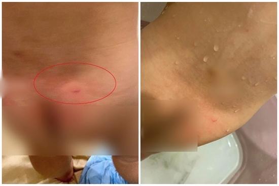 Phụ huynh ở Hà Nội phản ánh con 16 tháng đi học bị cấu và xịt nước nóng