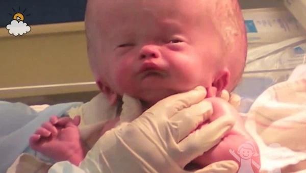 Bé trai sinh ra não úng thủy, dung mạo hiện tại khiến ai cũng trầm trồ-1